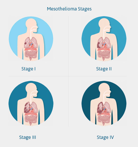 The 4 Stages of Mesothelioma  Popular Staging Systems