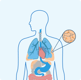 Mesothelioma tumors shown on lungs, abdomen and heart.