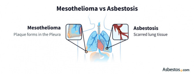 Mesothelioma vs asbestosis diagram