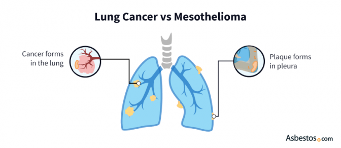 Diagram of a lung comparing malignant mesothelioma plaque in the lining versus a cancerous tumor