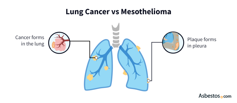 Diagram of a lung comparing malignant mesothelioma plaque in the lining versus a cancerous tumor