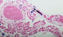 Mesothelioma cells under a microscope