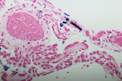 Mesothelioma cells under a microscope