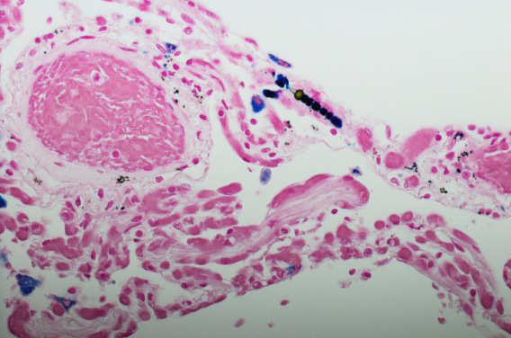 Mesothelioma cells under a microscope