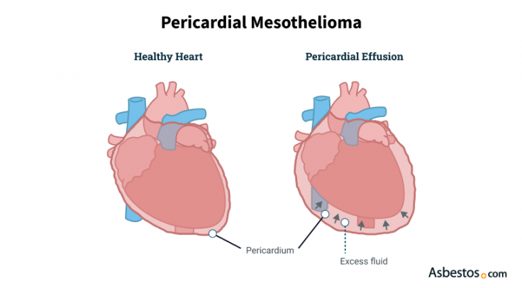 Diagram showing pericardial mesothelioma affecting the heart