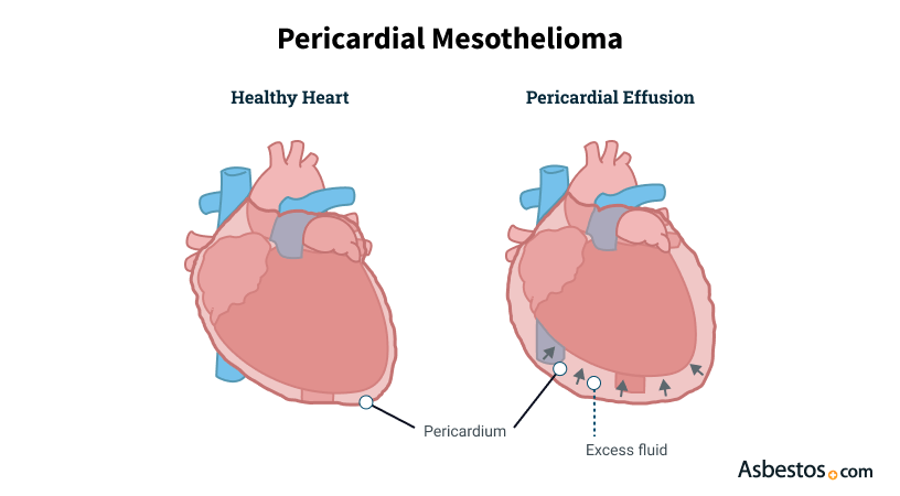 Diagram showing pericardial mesothelioma affecting the heart