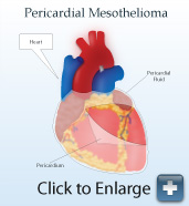 Diagram of pericardial mesothelioma