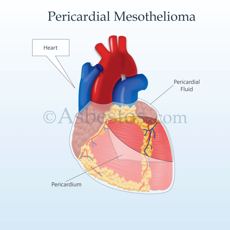 Are there any side effects associated with treatment of fluid around the heart?