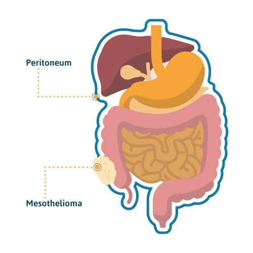 Peritoneal Mesothelioma: Causes, Treatment  Survival Rates