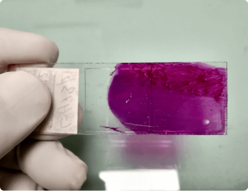 A gloved hand is holding a microscope slide stained pink to identify cancer cells.