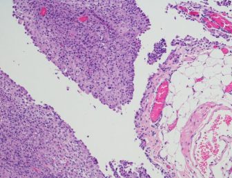 Peritoneal mesothelioma cells