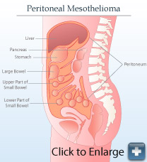 Peritoneal mesothelioma diagram