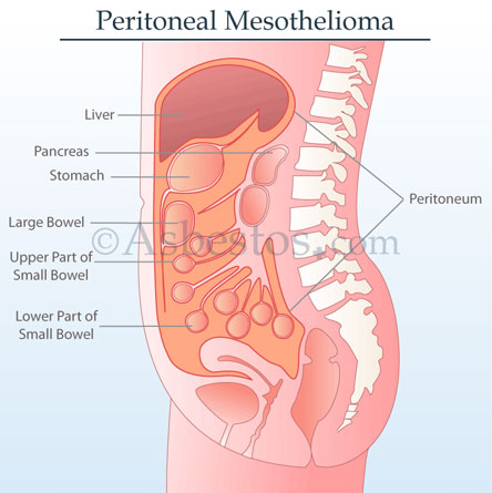 mesothelioma desmoplastic type