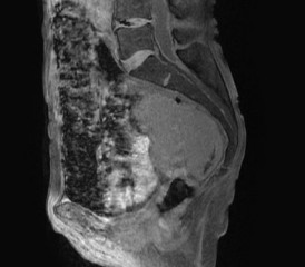 Peritoneal mesothelioma X-ray