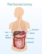 Diagram showing the six organs involved in a Peritonectomy or cytoreductive surgery