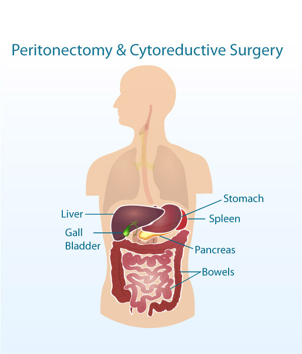 Diagram showing the six organs involved in a Peritonectomy or cytoreductive surgery