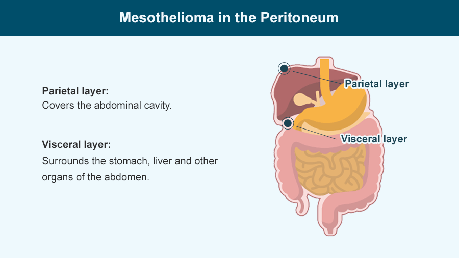 peritoneal-mesothelioma-causes-treatment-survival-rates