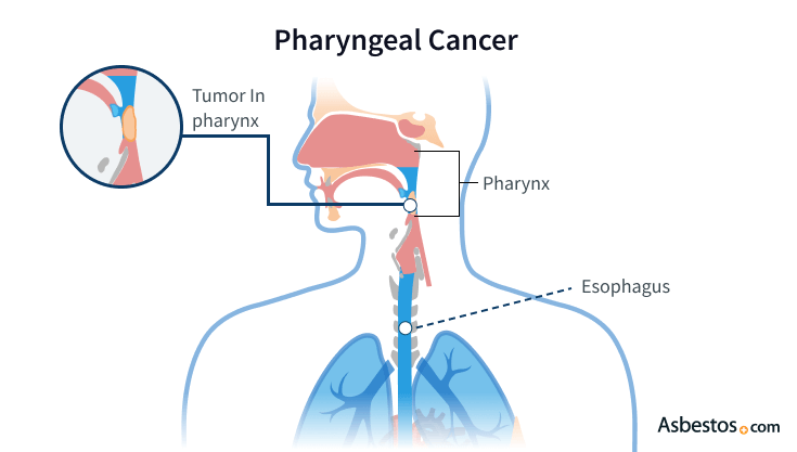 Diagram depicting a tumor in the pharynx and surrounding structures including the nasal cavity and esophagus.