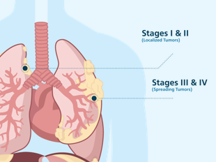 Pleural Mesothelioma - Symptoms, Diagnosis & Treatments