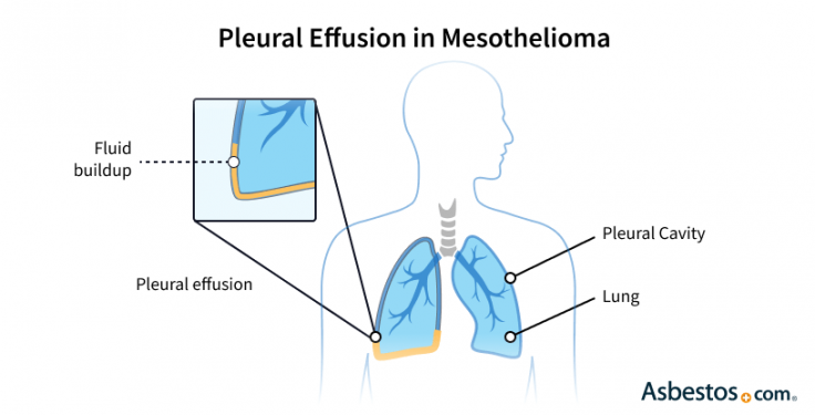 Pleural effusion in pleural mesothelioma