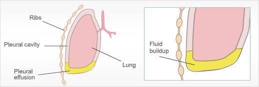 Benign asbestos pleural effusion