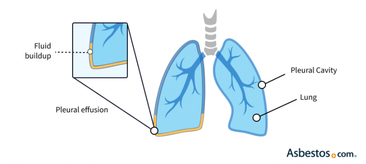 Benign asbestos pleural effusion