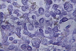 Cytology Fluid Stain of Mesothelioma Tissue