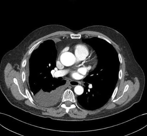 Malignant Mesothelioma CT Scan Malignant mesothelioma CT-scan