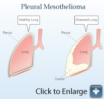 Healthy lung vs. a lung with mesothelioma diagram