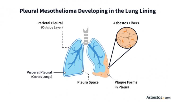 An illustration depicting how pleural mesothelioma develops in the lung linings. It highlights how plaque forms in pleura from asbestos fibers.