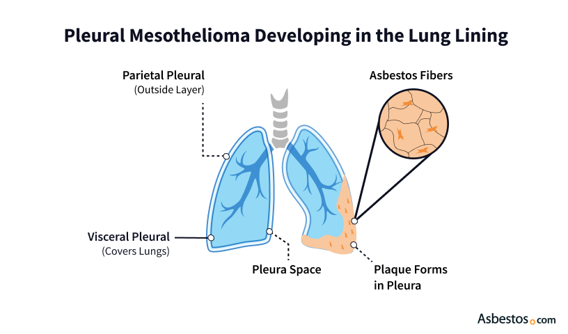 An illustration depicting how pleural mesothelioma develops in the lung linings. It highlights how plaque forms in pleura from asbestos fibers.