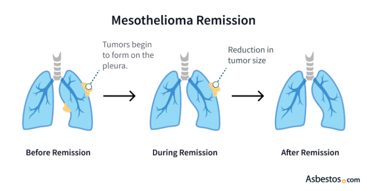 Comparison of lungs to illustrate pleural mesothelioma remission