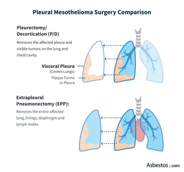 Pleural Mesothelioma Surgery Comparison