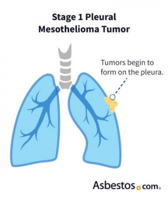 Early stage pleural mesothelioma forming