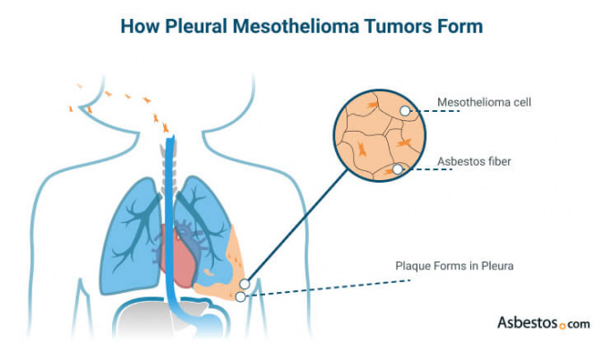 Pleural mesothelioma developing in the lungs caused by inhaled asbestos fibers