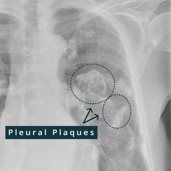 X-ray of calcified asbestos pleural plaques