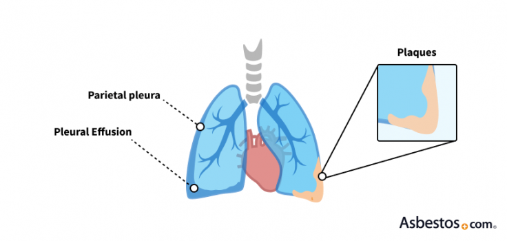 Pleural Plaques Caused by Asbestos