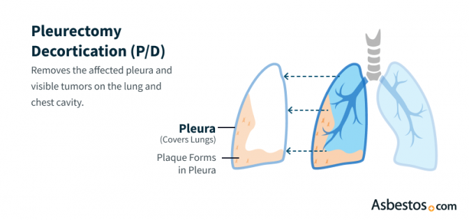 Pleurectomy decortication (P/D) surgery for pleural mesothelioma