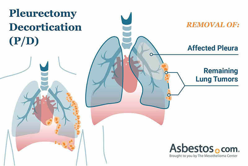 pleurectomy decortication pd surgery