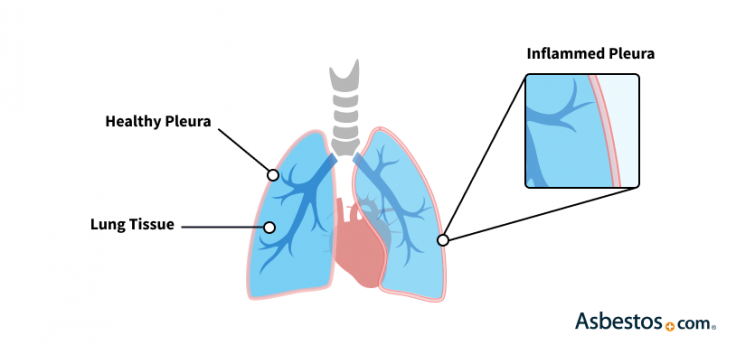 Pleuritis Caused by Asbestos