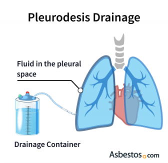pleurodesis drainage