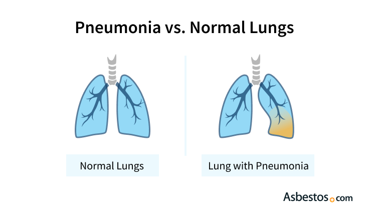 pneumonia in the left lung. The left lungs has a yellow haze in the base indicating infection, inflammation and fluid build-up