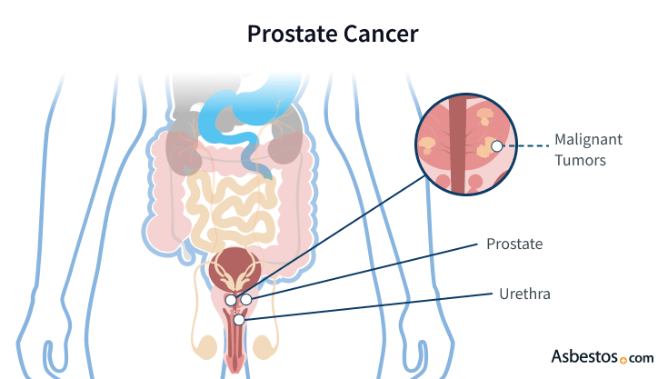Location of tumors in prostate cancer.