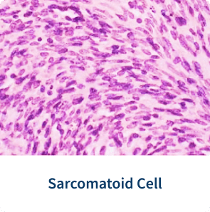 Sarcomatoid cell mesothelioma stain