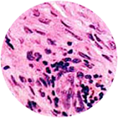 Sarcomatoid mesothelioma cell stain