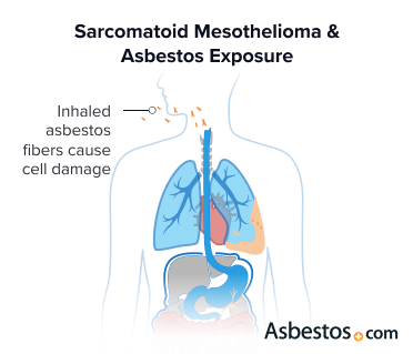 Mesmerizing Sarcomatoid Mesothelioma Versus Sarcomatoid Carcinoma Landscape in HD Mesmerizing Sarcomatoid Mesothelioma Versus Sarcomatoid Carcinoma Landscape in HD