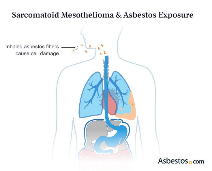 Diagram of how inhaling asbestos fibers can cause sarcomatoid mesothelioma.