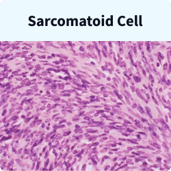 Sarcomatoid mesothelioma cells