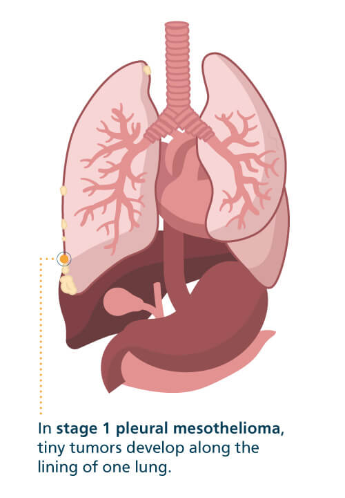 Mesothelioma What is Malignant Mesothelioma Cancer Mesothelioma What is Malignant Mesothelioma Cancer