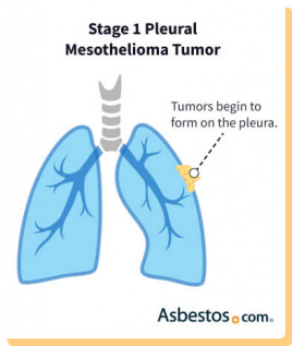 Stage 1 mesothelioma tumor progression